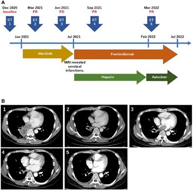 Case report: anaplastic lymphoma kinase (ALK) rearranged adenocarcinoma with high level of microsatellite instability response to pembrolizumab